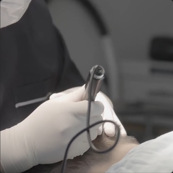 연세모벨르의원 SMP 두피문신